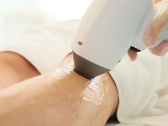 Epilacja laserowa - Odkrywając skuteczne metody pozbywania się owłosienia