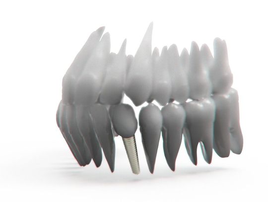 Implanty zębów – kiedy trzeba po nie sięgnąć?