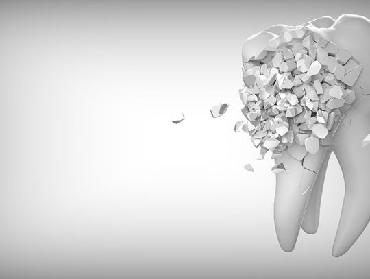 Leczenie kanałowe zębów – co powinieneś o nim wiedzieć?