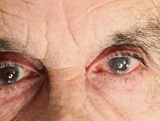 Operacja zaćmy – możliwe komplikacje