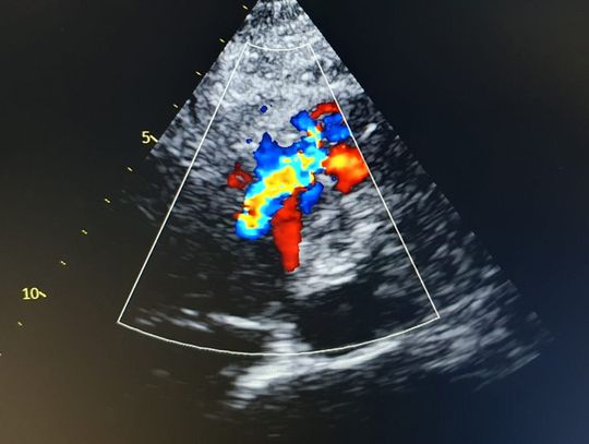 W starogardzkim szpitalu przeprowadzono skuteczny zabieg przezskórnego zamknięcia pozawałowego ubytku w przegrodzie międzykomorowej W starogardzkim szpitalu przeprowadzono skuteczny zabieg przezskórnego zamknięcia pozawałowego ubytku w przegrodzie międzykomorowej