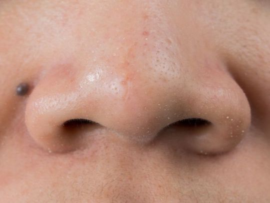 Wągry - problem nie tylko nastolatek