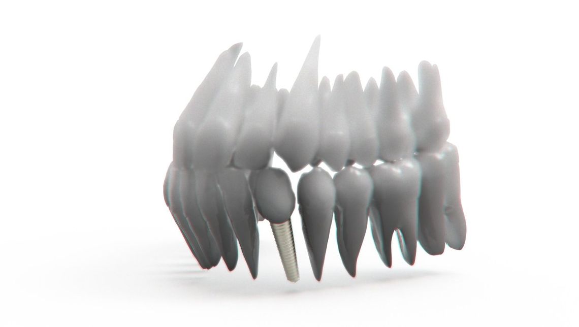 Implanty zębów – kiedy trzeba po nie sięgnąć?