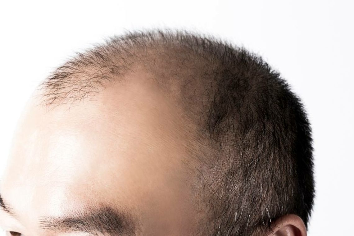 Jaki wpływ na problem z wypadaniem włosów ma DHT?