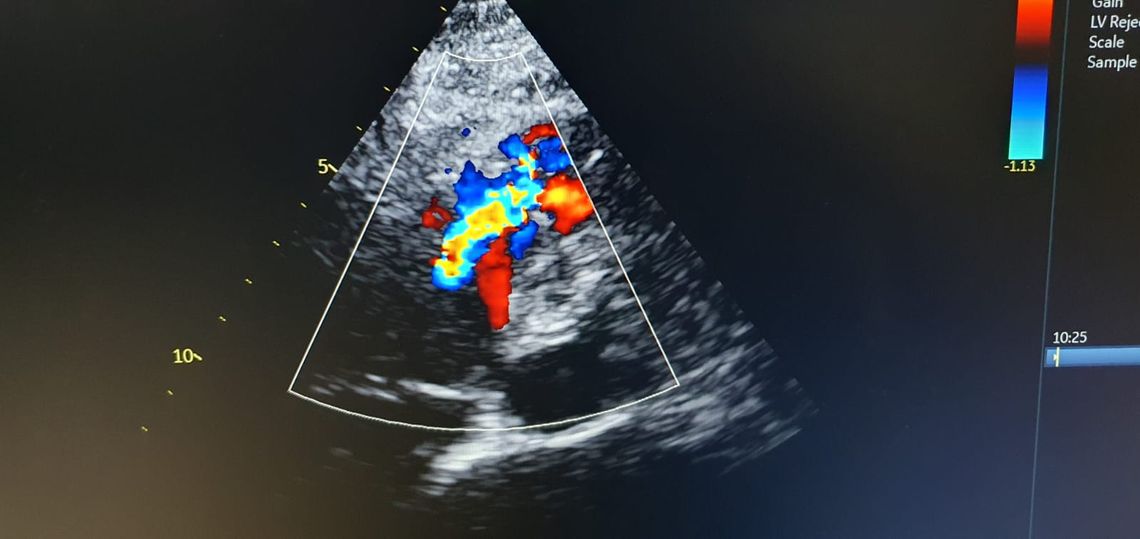 W starogardzkim szpitalu przeprowadzono skuteczny zabieg przezskórnego zamknięcia pozawałowego ubytku w przegrodzie międzykomorowej